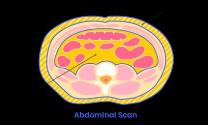 Illustration of the distribution of subcutaneous fat vs visceral fat