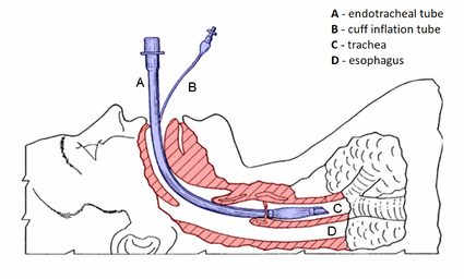 an image of endotracheal tube placed in trachea