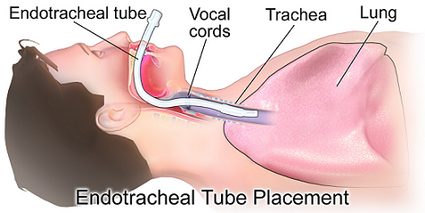 Endotracheal Tube