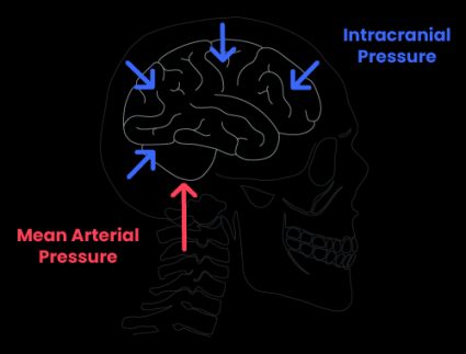 CPP illustration with mean arterial pressure (MAP) and intracranial pressure (ICP).