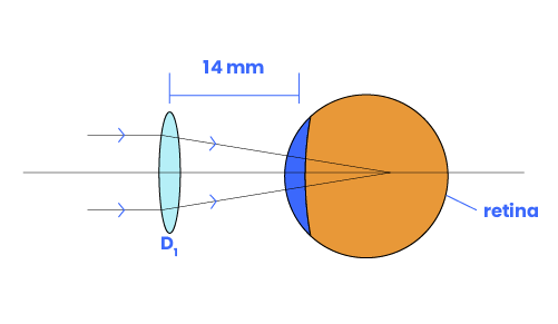 Contact Lens Vertex Calculator   Contact Lens Vertex 02 