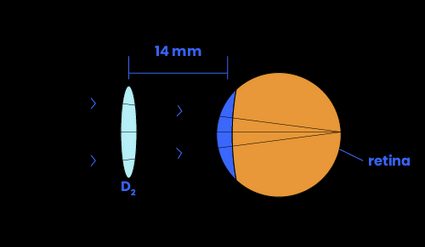 A vertex compensated lens focuses the image onto the retina.