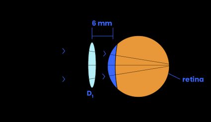 Eyeglass moved a distance towards from the eye refracts the image beyond the retina.