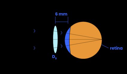 A vertex compensated lens focuses the image onto the retina.