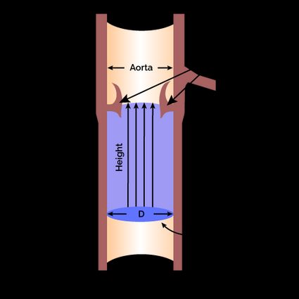 LVOT visualized as a cylinder