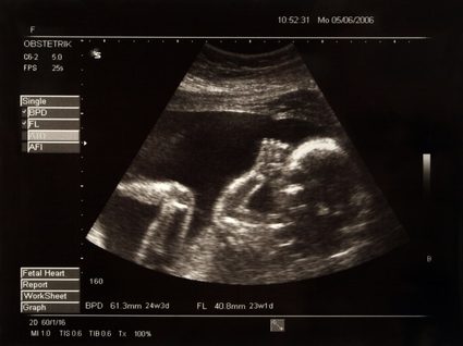 USG w ciąży służące do wyznaczenia daty porodu.