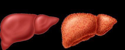 Cirrhosis of the liver