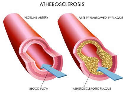An image showing how atherosclerosis narrows down the artery.