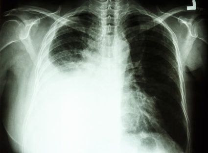 A chest xray with pleural effusion on the right side