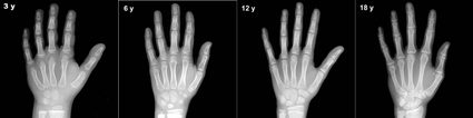 Różnice w długości kości ręki u dzieci w wieku 3, 6, 12 i 18 lat.