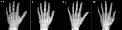 The difference in length of hand bones in children aged 3, 6, 12, and 18